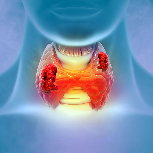 Thyroid nodule ablation