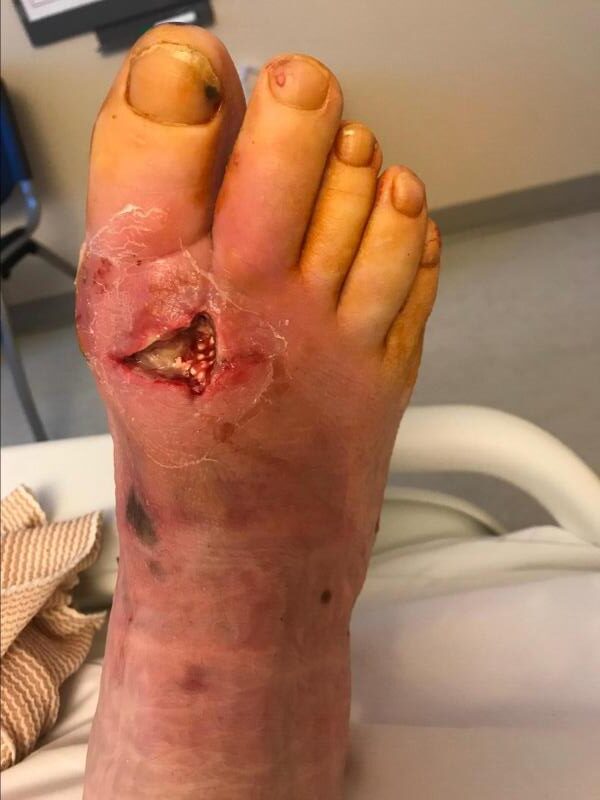 Diabetic Foot Infection rotated Dr Gaurav Gangwani